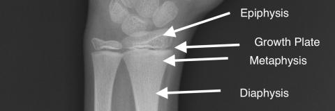 Visual depiction of the bone shaft (diaphysis), growth plate, and epiphysis